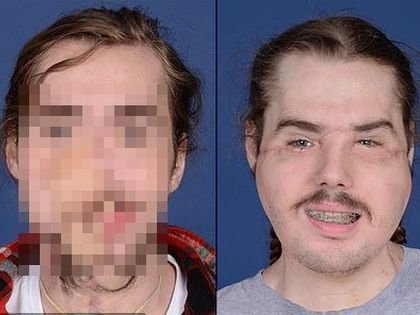 【閲覧注意】ショットガン自殺未遂の男、フル顔面移植に成功! 超衝撃ビフォーアフター、完全崩壊した顔が別人に=米