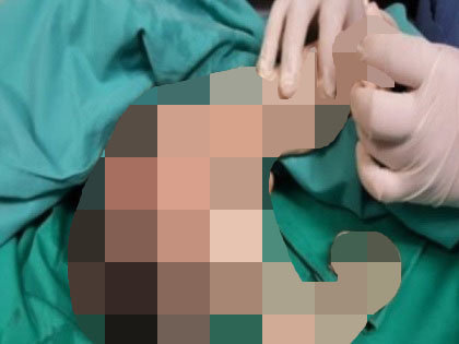 【閲覧注意】少年の胃の中で密かに成長していた兄弟 – ふさふさ髪からペニスまで形成された「成熟奇形腫」の恐ろしい姿＝マレーシア