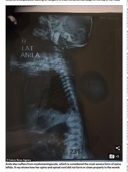 【閲覧注意】母親「我が子の頭部が恐ろしい」 脳が頭蓋骨から“押し出された”赤ん坊が誕生! 小さな傷も大ダメージに…=パキスタン