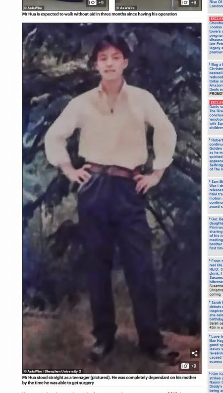 【閲覧注意】「折り畳まれた男」が悲惨! 太ももと顔面がくっついて20年、“背骨を折る”難手術の末に…