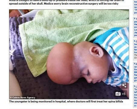 【閲覧注意】母親「我が子の頭部が恐ろしい」 脳が頭蓋骨から“押し出された”赤ん坊が誕生! 小さな傷も大ダメージに…=パキスタン