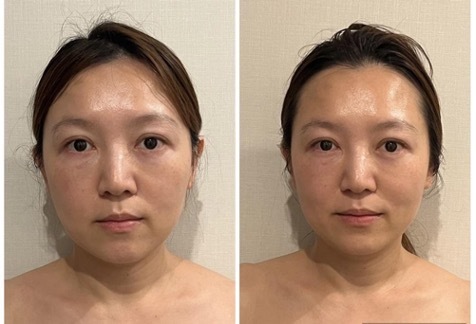 24時間でこんなに小顔に!? 最先端「波動美容」の実力がやばい