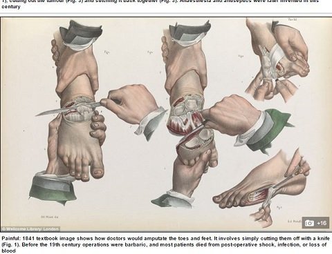 【閲覧注意】19世紀の外科手術が怖すぎる、痛すぎる、残酷すぎる！