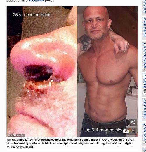 【閲覧注意】コカインを25年間やり続けた男の鼻はこうなる! 肉が腐れ落ち、穴がつながり… 悲惨すぎる代償=英