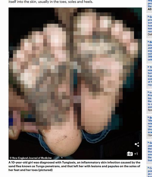 【閲覧注意】豚小屋を裸足で歩いた少女の足裏がとんでもないことに! 「スナノミ症」のブツブツに鳥肌必至…
