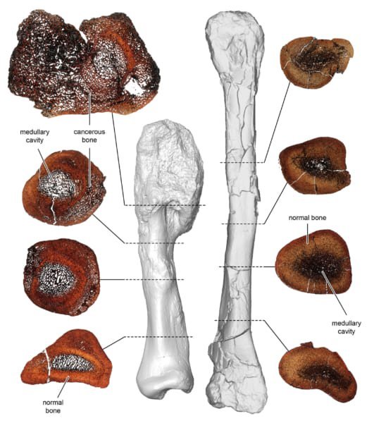 史上初、恐竜がヒトと同じ「骨のがん」に罹っていた証拠を発見！　がんの進化を解明する上で貴重な資料に