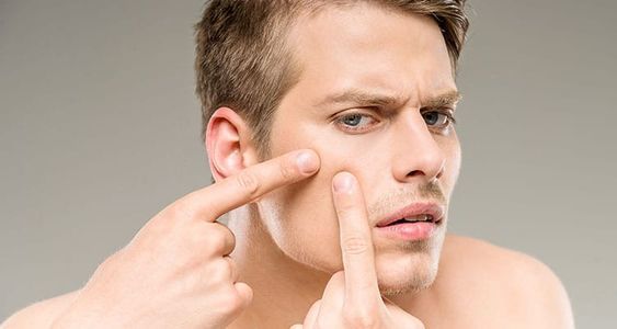 男(メンズ)のニキビ肌予防に効果があるスキンケアとは？正しいケアを解説！