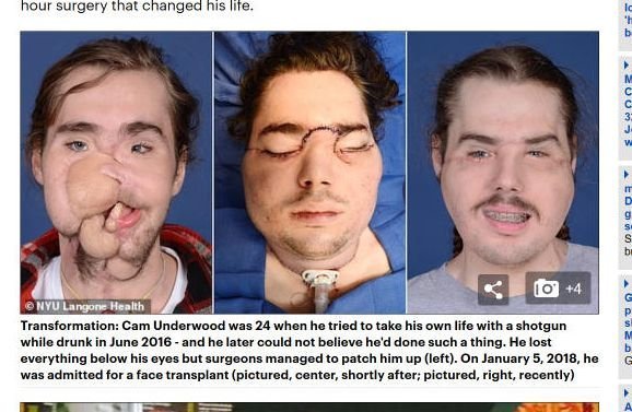 【閲覧注意】ショットガン自殺未遂の男、フル顔面移植に成功! 超衝撃ビフォーアフター、完全崩壊した顔が別人に=米