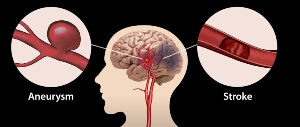 ジョイスティックで脳梗塞を「遠隔手術」できる技術が登場！
