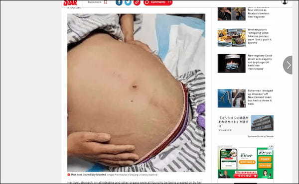 まるで20kgのニシキヘビ… 重度の便秘に悩む女性から摘出された「巨大すぎる便」