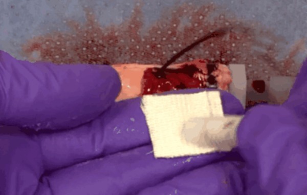 「フジツボ」からどんな出血も15秒で止血できる接着剤を開発