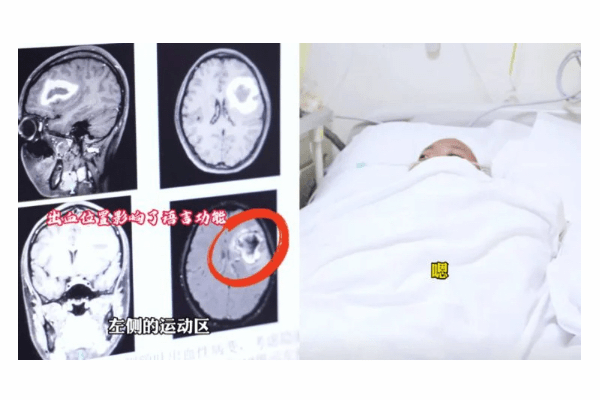 突如「特定の言語だけ話せなくなった」24歳女性襲った謎の病の画像2