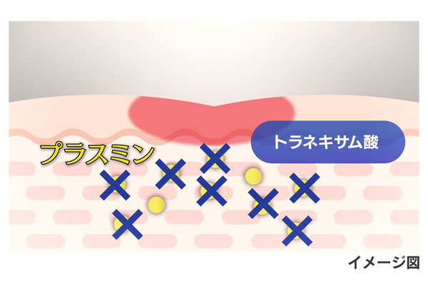 生活者と共創し革新を続ける…第一三共ヘルスケア、トラネキサム酸研究開発の最前線の画像2