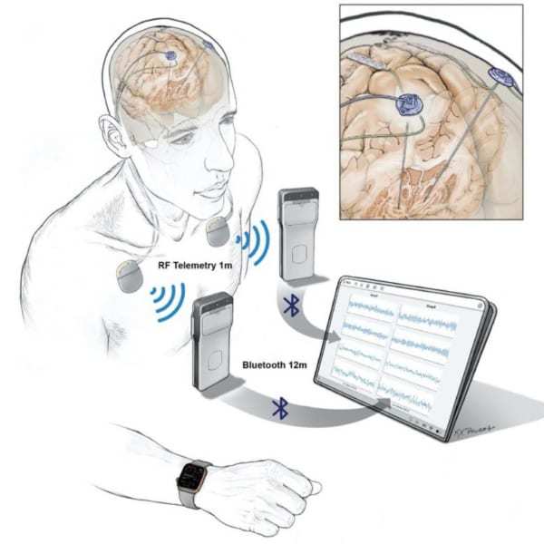 日常生活を送りながら患者の脳活動を記録できるデバイスが誕生