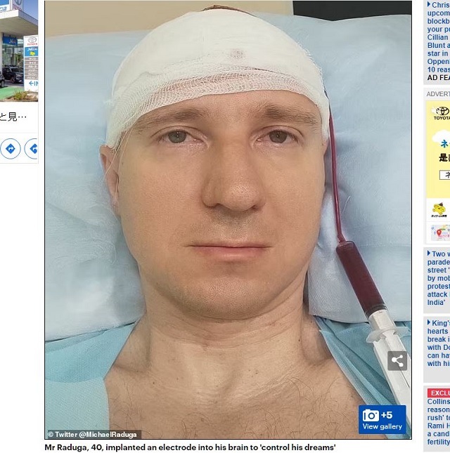 素人が自分自身に脳外科手術を敢行！ ロシアのリアルブラックジャックに医師が警鐘を鳴らす