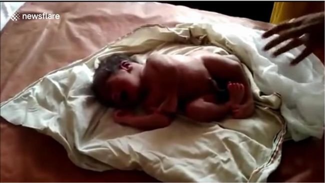 【閲覧注意】4本の足と2つのペニスをもつ赤ん坊が誕生! 殺されてしまう事例も… 住民が押し寄せ大ニュースに=インド
