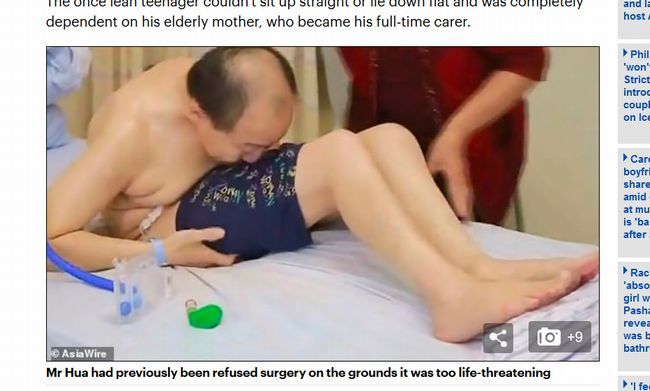 【閲覧注意】「折り畳まれた男」が悲惨! 太ももと顔面がくっついて20年、“背骨を折る”難手術の末に…