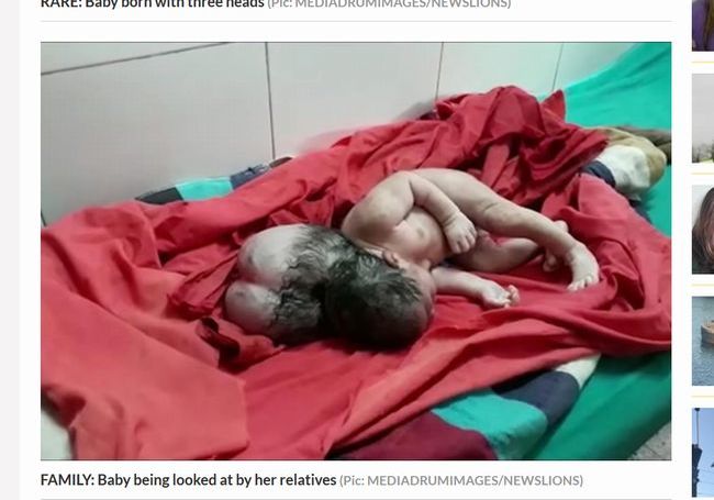 【閲覧注意】インドで“3つの頭”を持つ赤ん坊が誕生! 重篤すぎる先天異常の原因とは…