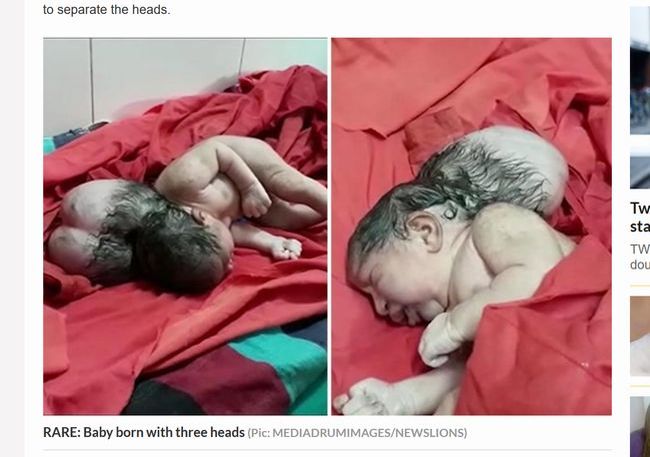 【閲覧注意】インドで“3つの頭”を持つ赤ん坊が誕生! 重篤すぎる先天異常の原因とは…