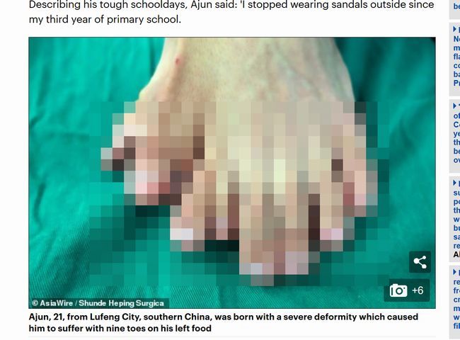 【閲覧注意】左足指が“9本ある”中国人男性がスゴい！ コンプレックスに耐えかねて切除手術を受けた結果…！