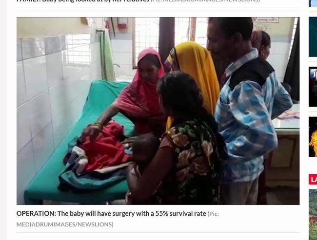 【閲覧注意】インドで“3つの頭”を持つ赤ん坊が誕生! 重篤すぎる先天異常の原因とは…