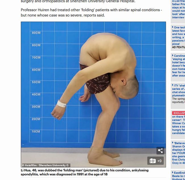 【閲覧注意】「折り畳まれた男」が悲惨! 太ももと顔面がくっついて20年、“背骨を折る”難手術の末に…