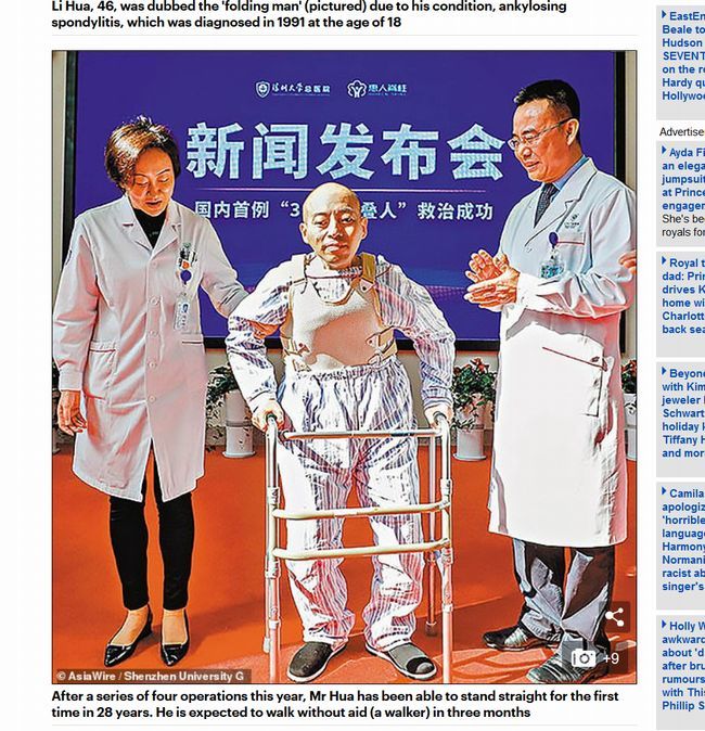 【閲覧注意】「折り畳まれた男」が悲惨! 太ももと顔面がくっついて20年、“背骨を折る”難手術の末に…