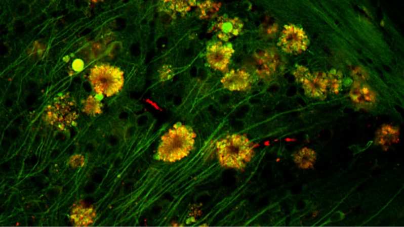 脳細胞に咲く「毒の花」がアルツハイマー病の真の原因と判明！