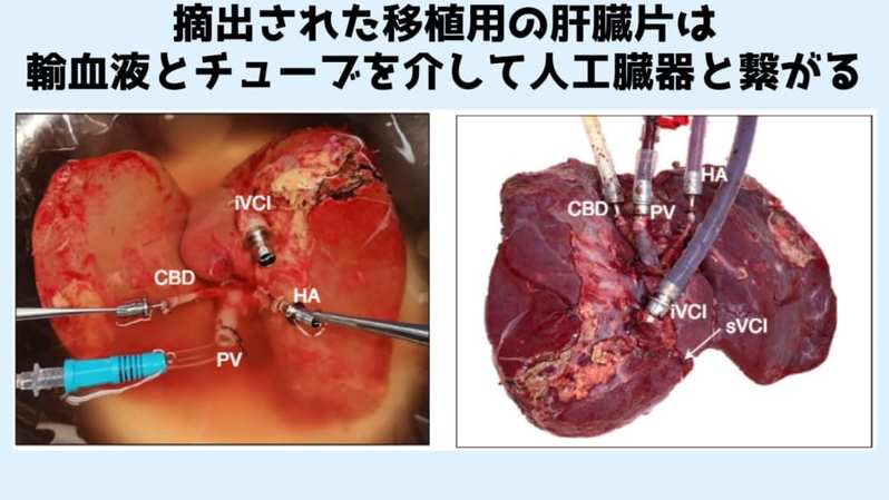 摘出した肝臓を機械に繋いで3日間「体外治療」し移植することに成功!