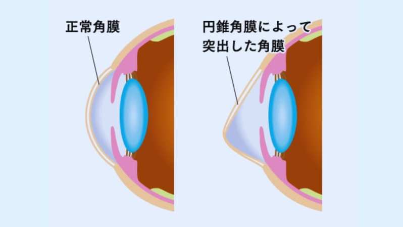 ブタの皮膚から作られた「角膜」で失明患者20名の視力を回復させることに成功