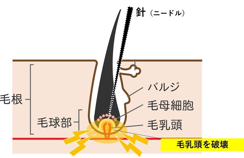 【髭脱毛】効果が出るのは何回目？気になる回数と効率よく終わらせる方法