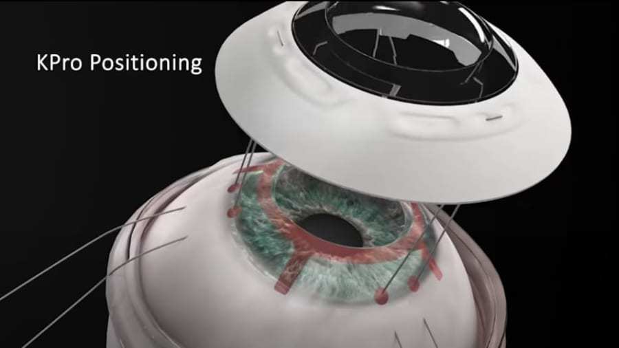 ドナーいらず「新しい人工角膜」の移植手術に成功！ コンタクトレンズのように目を覆い手術を簡略化